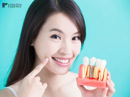 Những lưu ý của việc trồng răng implant mà bạn nên biết