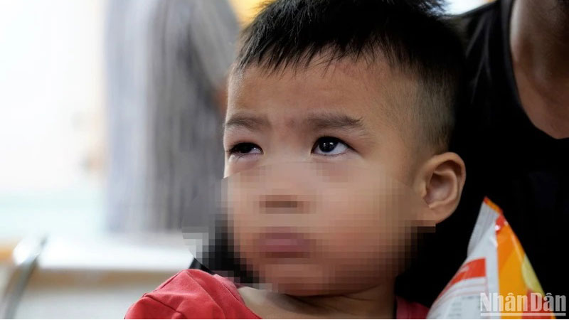 Vì sao không nên nhỏ sữa, xông lá trầu khi điều trị đau mắt đỏ