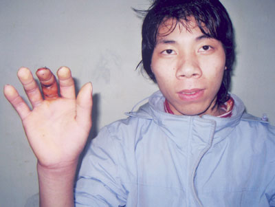 Phẫu thuật thành công nối ngón tay bị cắt đứt